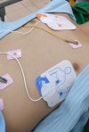 Hình ảnh máy tạo nhịp tạm thời qua da