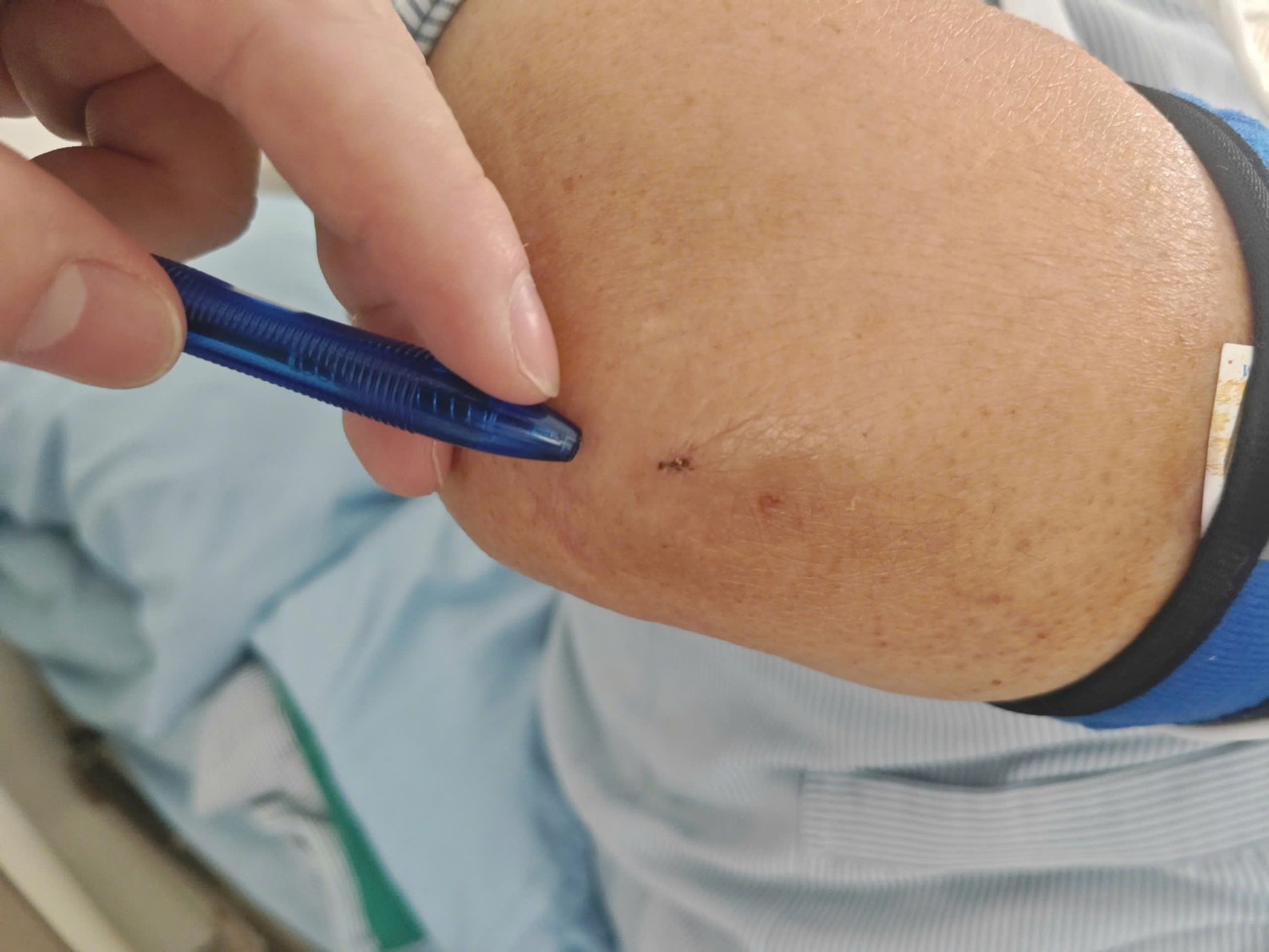 Vết mổ chỉ bằng đầu bút bi, rất ít đau