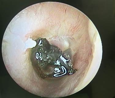 Mảnh than đá yên vị trong tai người bệnh